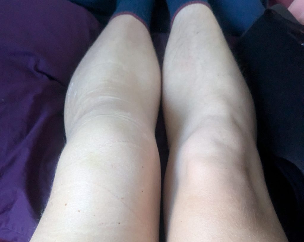 swollen knee